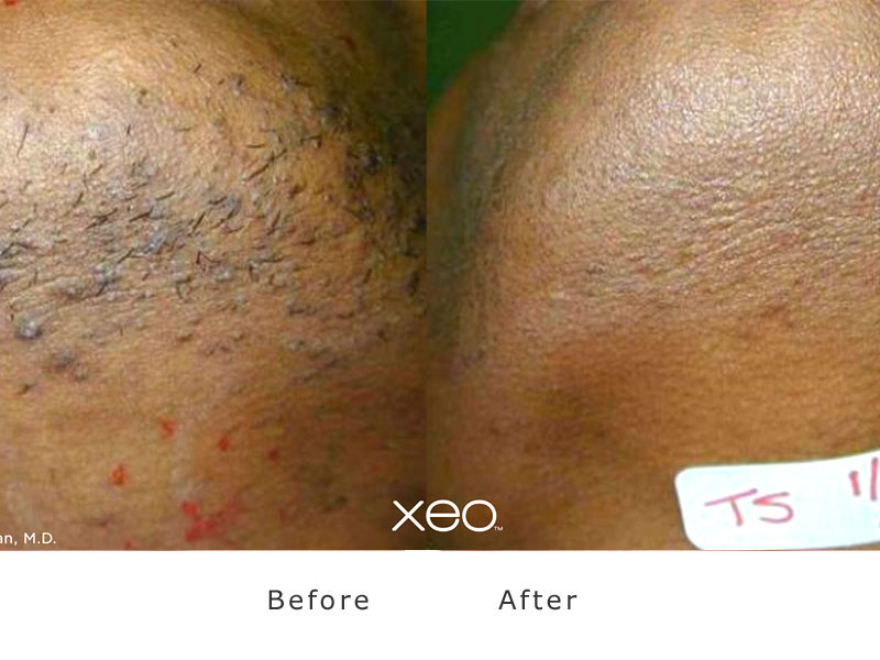 laser treatments pseudofollitis barba at laser hair removal blackburn road