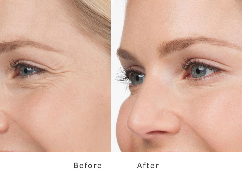 before and after treatment of botox