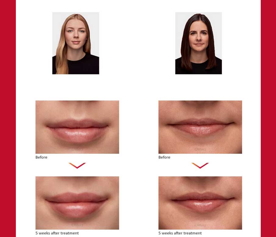 BEFORE AND AFTER RESULTS USING BELOTERO LIPS
