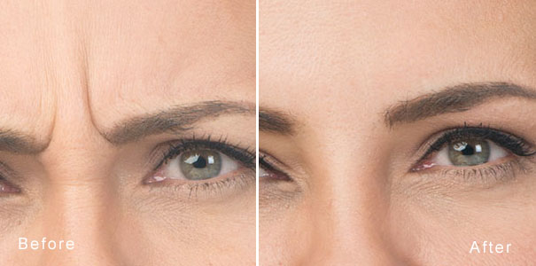 Botox clinic before and after anti wrinkle injections