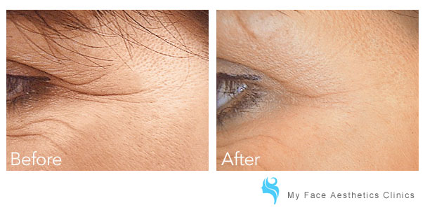 before and after fine lines have been injected
