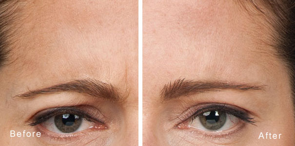 reduction of crows feet around the eyes using a dermal filler