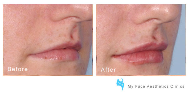 deral filler showing improvement to jowl and jawline