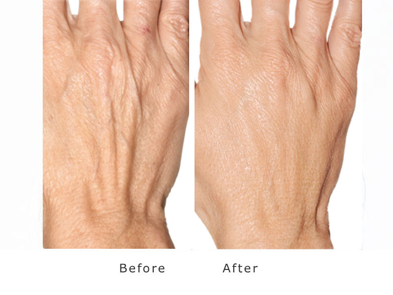 increase in volume and smoothing effect of dermal filler to hands