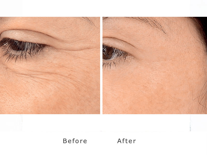reduction of crows feet around the eyes using a dermal filler
