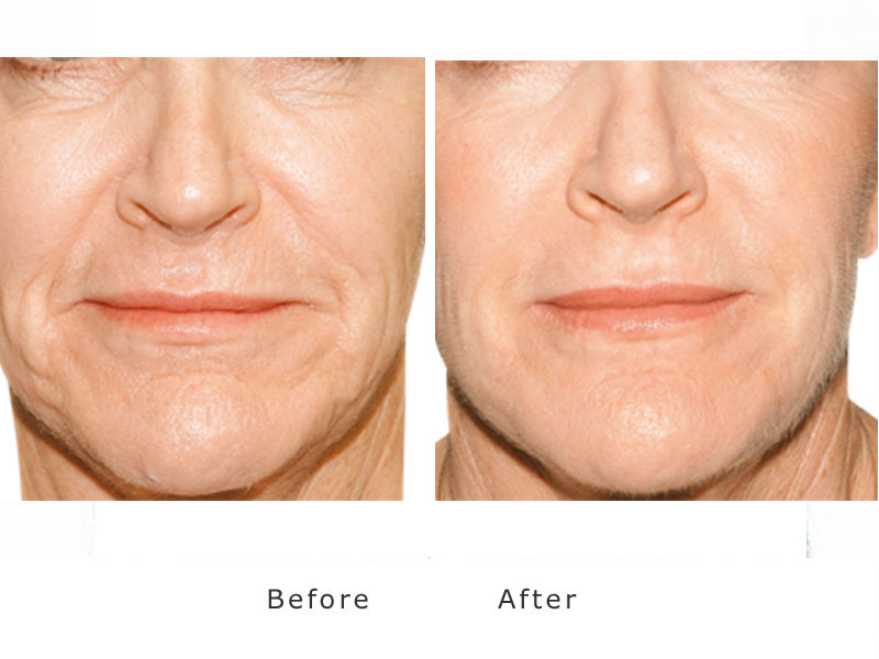 skin smoothing and plumping using a dermal filler to the nasiofolds and marionette