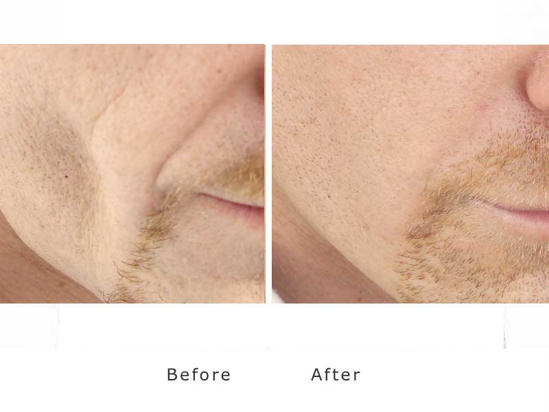 using dermil fillers to plump out and smooth the cheeks on a man - cheeks jowls