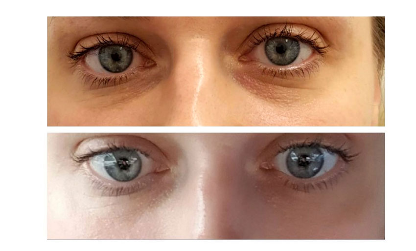 ageing eye area treatment using iridium cONTOUR BEFORE AND AFTER EYE TREAMENT PHOTOGRAPH