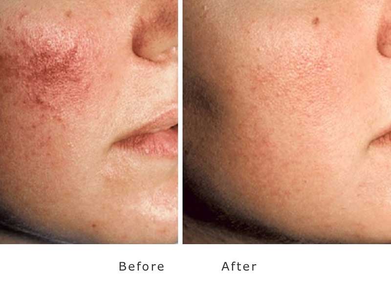 skin rejuvenation with Cutera limelight treating skin redness, tiny viens and brown spots