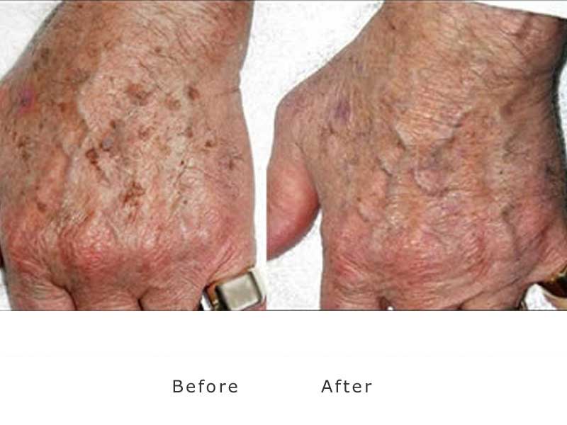  brown spots to hands before and after treatment