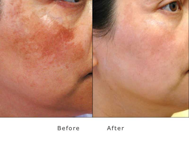 skin redness treated with ipl laser