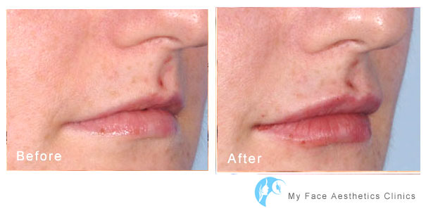 increase to lip volume and shape to lips aesthrtic enhancement at my face aesthetics