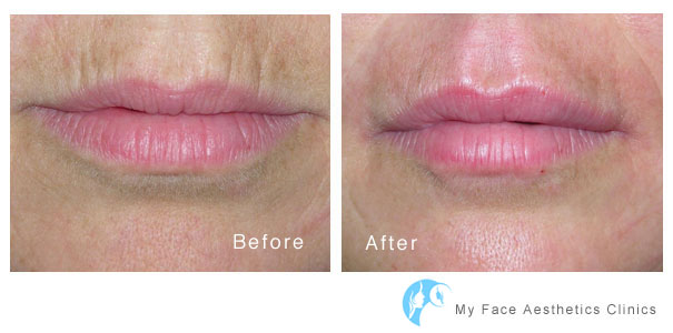 lip fillers volume replacement to womens lips