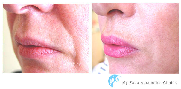 icreasing lip volume and shape in the bolton aesthetic clinic using fillers