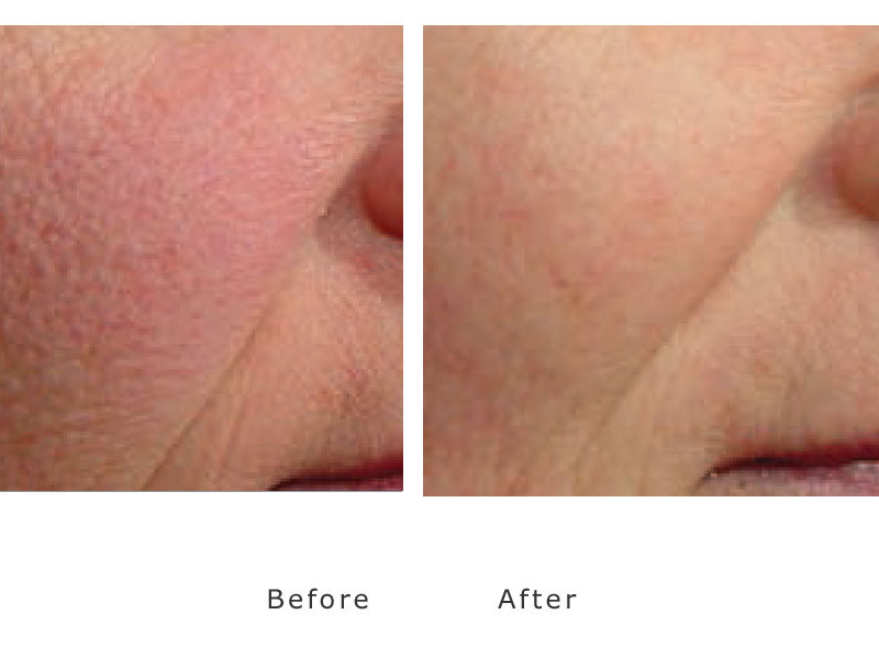 red cheeks treated by gensis laser
