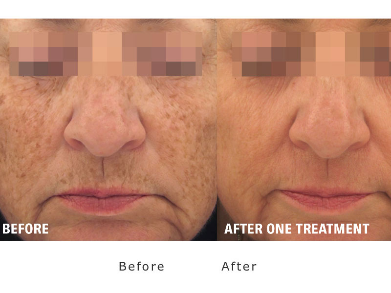 smoother skin after one treatment of xeo laser