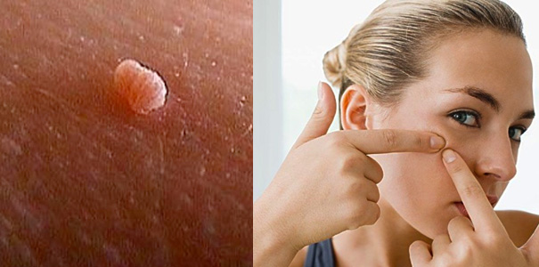 skin tag causes and treatment
